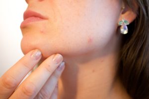 photo-peeling-visage-complications-possibles