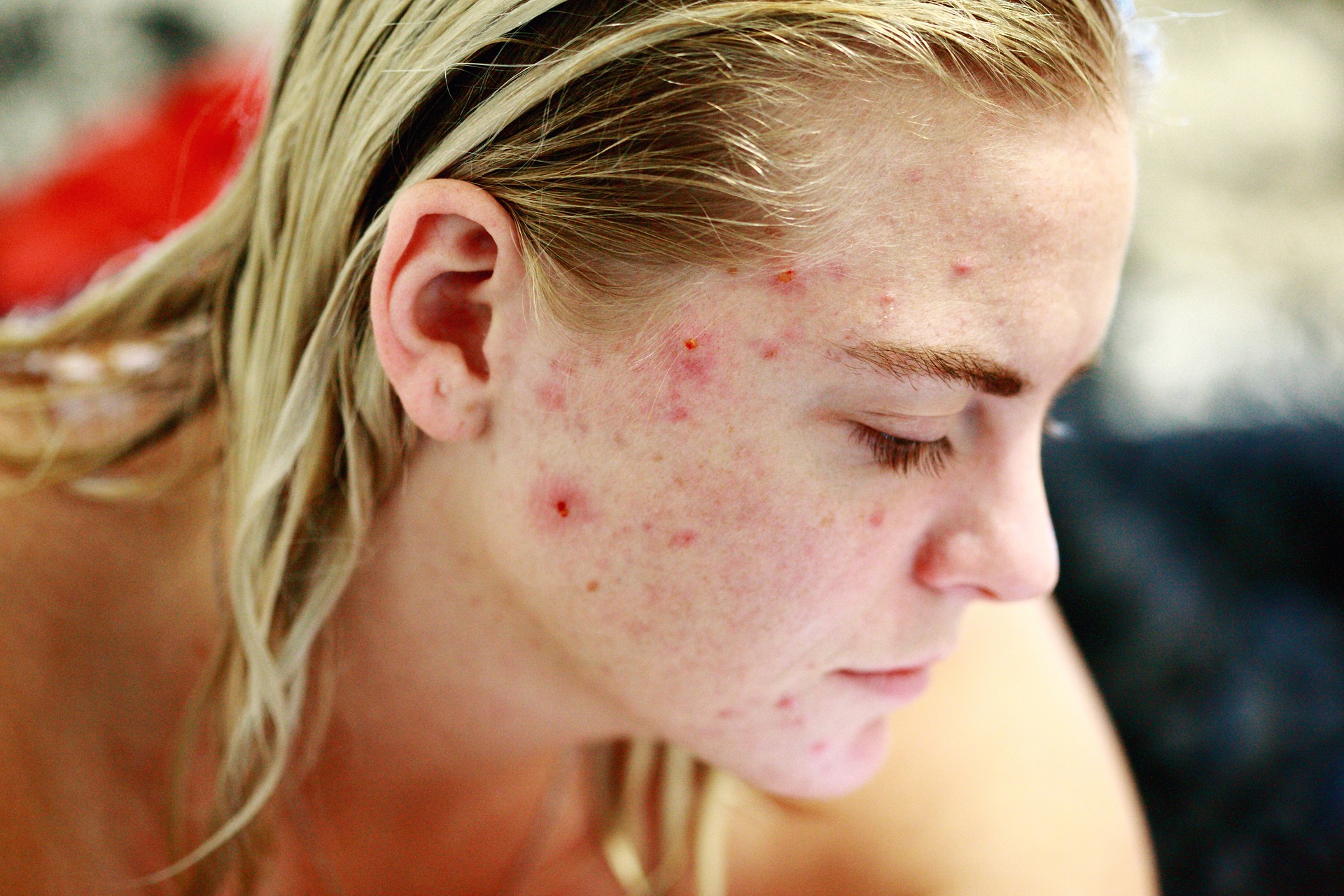 photo-pelling-tca-acne-cicatrices